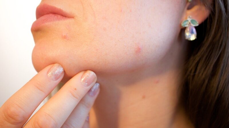 Acne Skin Care Products and Treatments