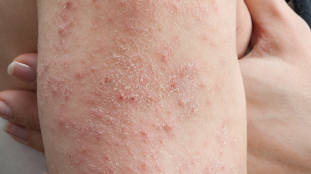 Skin Rashes: Allergic vs Autoimmune