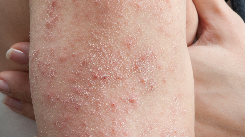 skin rash caused by allergy