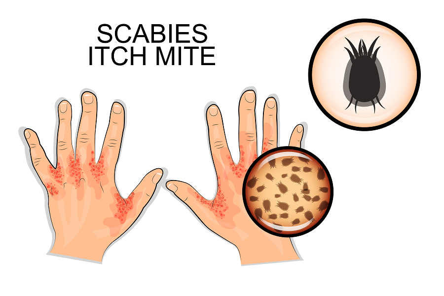 scabies skin infection