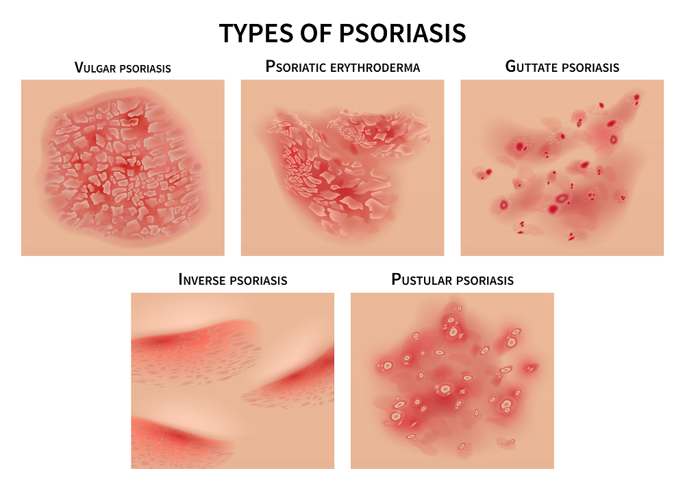 The Condition of Psoriasis