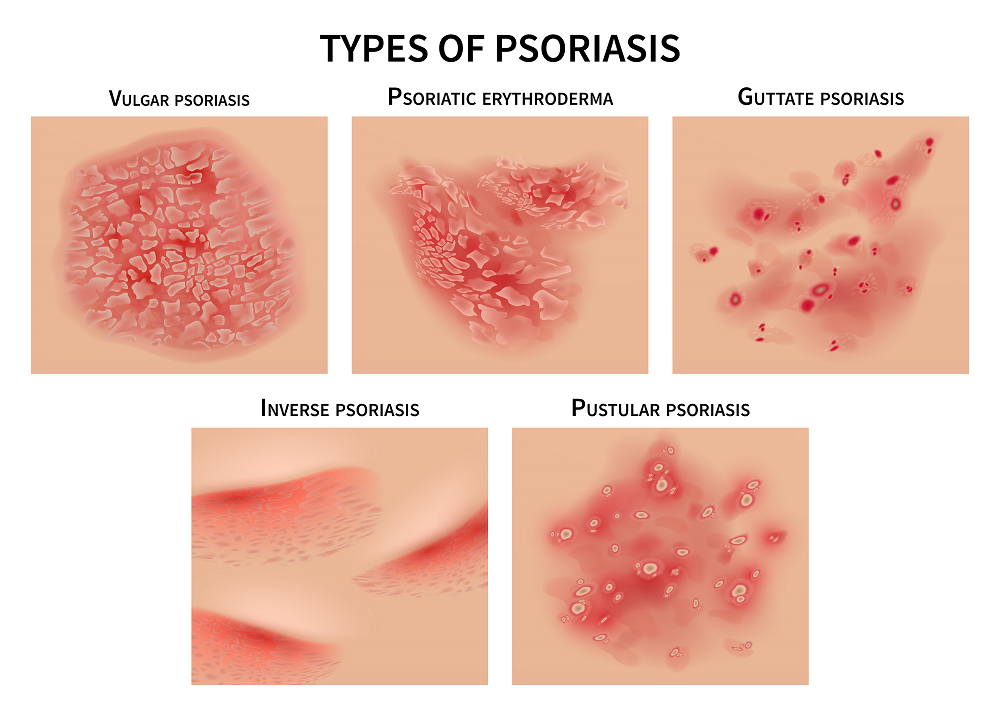 different types of psoriasis